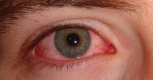 What is commonly misdiagnosed as pink eye