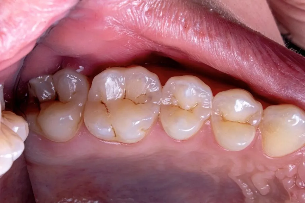 What is the strongest natural antibiotic for tooth infection